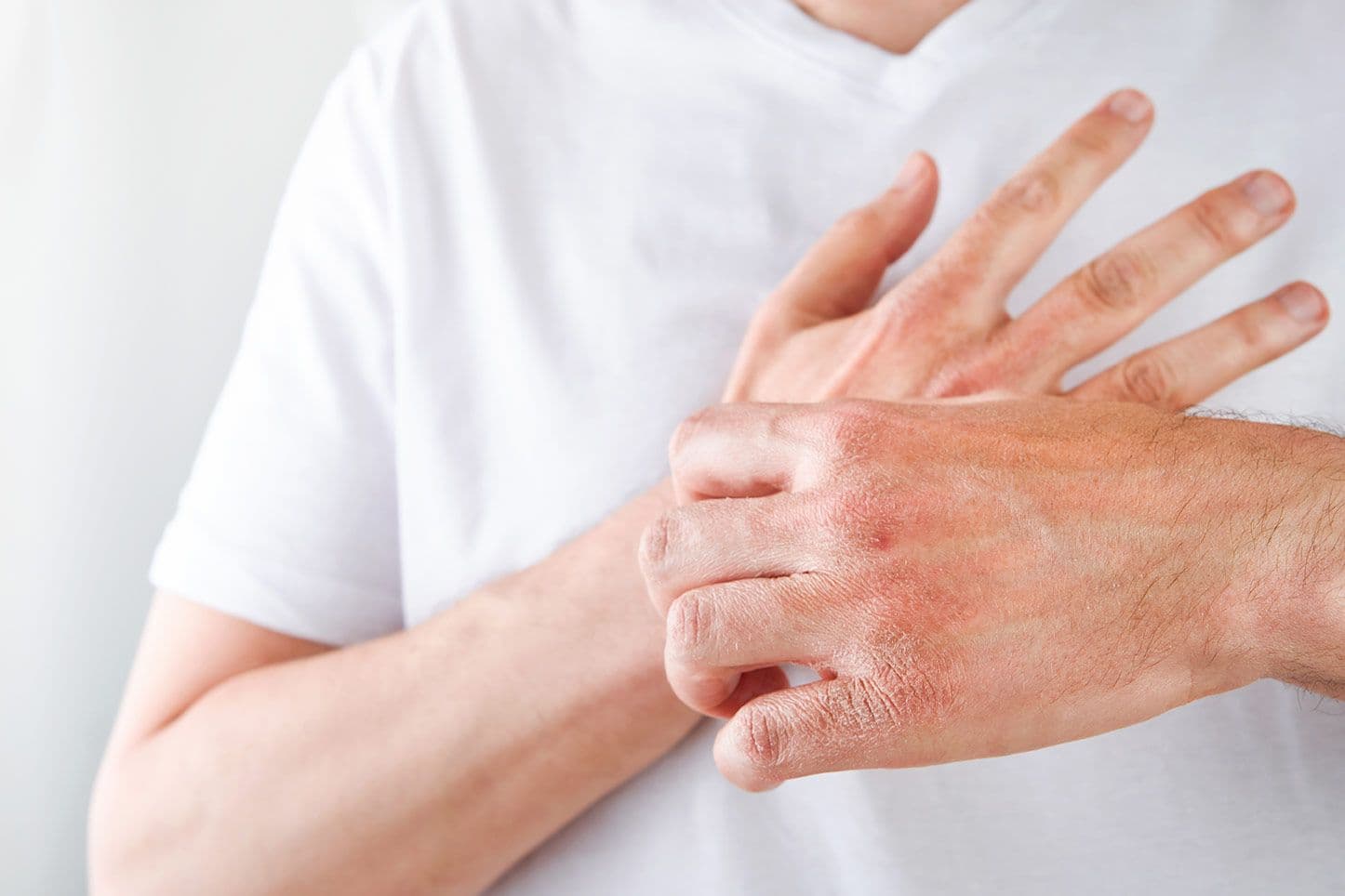 Person kratzt sich an geröteter, gereizter Haut auf der Hand